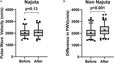 Treatment Site Does Not Affect Changes in Pulse Wave Velocity but Treatment Length and Device Selection Are Associated With Increased Pulse Wave Velocity After Thoracic Endovascular Aortic Repair